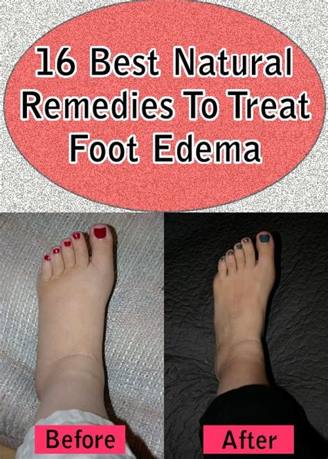 8 Mistakes You Make About Thin Hair Foot Remedies Swelling Remedies