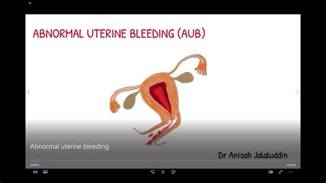 Abnormal Uterine Bleeding Youtube