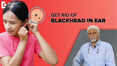 How To Get Rid Of Blackheads In The Ear Ear Blackheads Dr Harihara