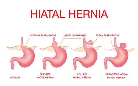 What Are The Different Types Of Hiatal Hernia Images And Photos Finder