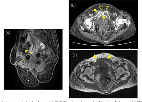 Figure 1 From Osteomyelitis Pubis Caused By Pseudomonas Aeruginosa Secondary To Surgical Site
