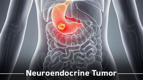 Neuroendocrine Tumor Causes Symptoms Diagnosis Prognosis Treatment
