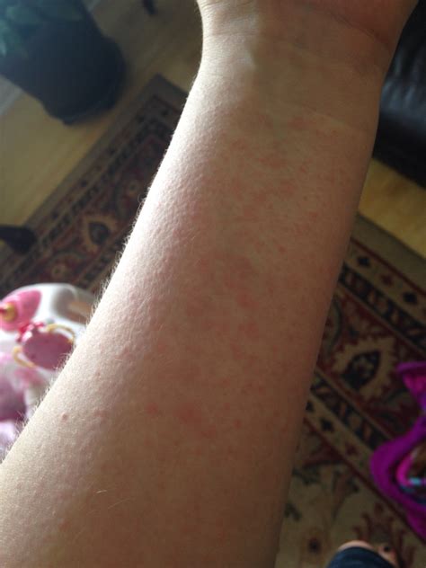 Random Itchy Rash On My Body — The Bump