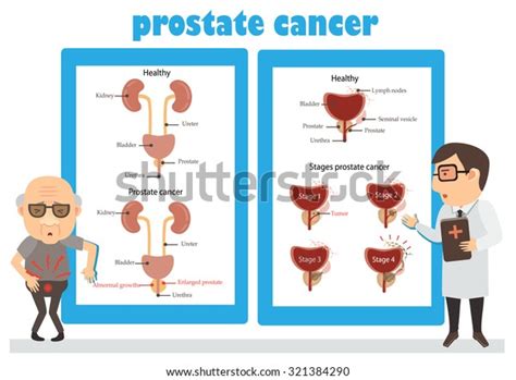 Stages Prostate Cancer Cancer Consultation Man Stock Vector Royalty
