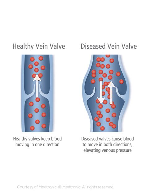 Varicose Vein Treatment Vascular Care Of Texas
