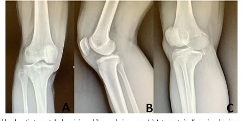 Figure 1 From Osteochondral Avulsion Fracture Of The Posteromedial