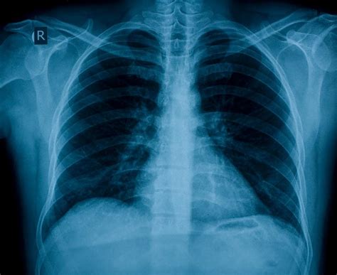 Estudo brasileiro identifica Covid por raio X com de eficácia Portal de Notícias