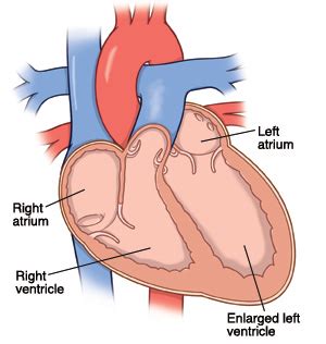 What side is your heart on? Left-Sided Congestive Heart Failure