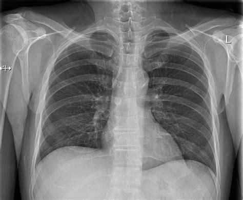 Labeled chest radiographs teaching radiologic anatomy with a level of detail appropriate for medical students. Practice Chest X-Ray Interpretation