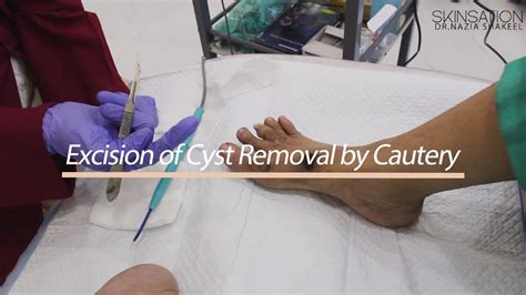Excision Of Cyst Removal By Cautery And Wart Removal By Co2 Laser Youtube