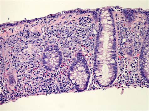 Microscopic Colitis Gastroenterology