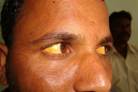 A Case Of Jaundice From Mumbai Serum Bilirubin 1417 Homeo Energy