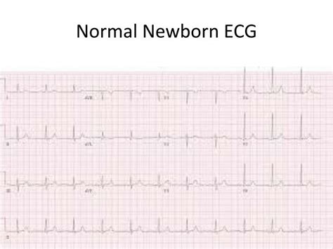 Normal Neonatal Ecg