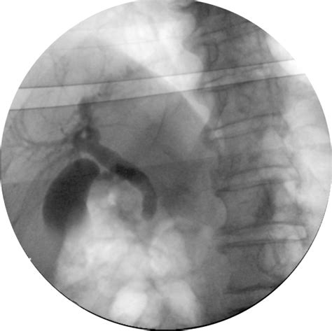 Endoscopic Retrograde Cholangiopancreatography Showing An Occlusion