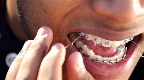 What Happens If Your Braces Wire Is Loose Braces Explained