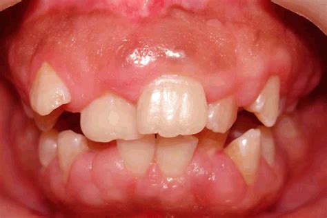 Pronounced Hereditary Gingival Fibromatosis Shown In A Child From