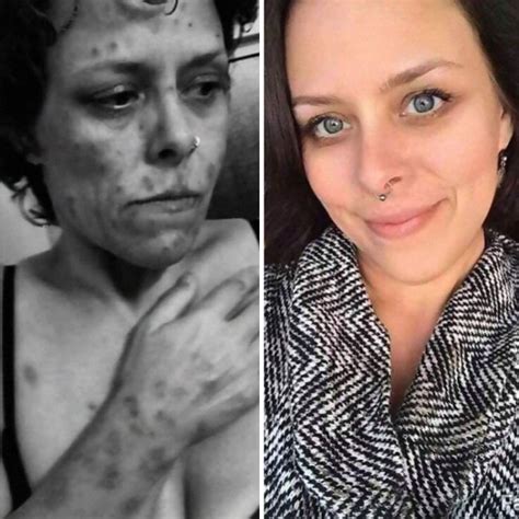 Amazing Transformations Of Drug Addicts Before And After Getting Sober