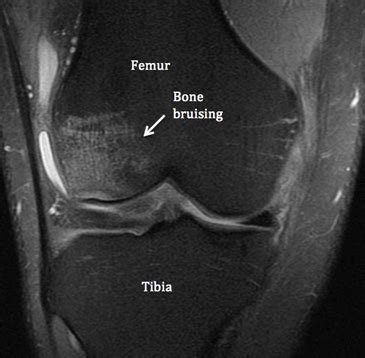 Bone Bruises What Are They Ramsay Healthcare