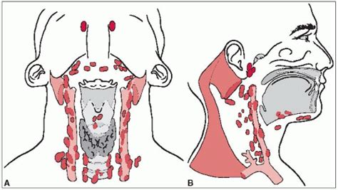 Oral Cavity Oncohema Key