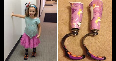 She Can Fly Girl 4 Gets Prosthetic Running Legs Thanks To Help From
