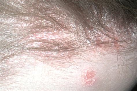 Perianal Streptococcal Dermatitis In Adults