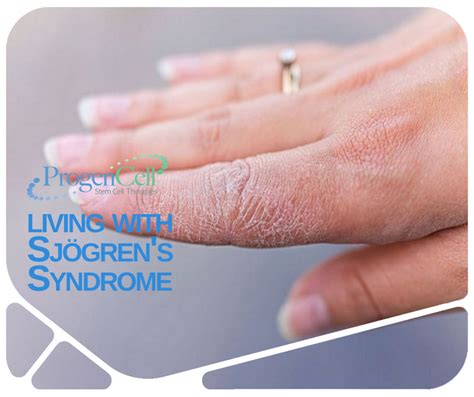 Living With Sjögren Syndrome Tips To Get Better Progencell
