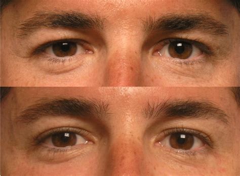 The 3 Types Of “droopy Eyelids”