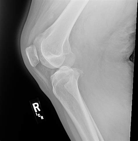 Compartment Syndrome Secondary To Vascular Transection From A Knee