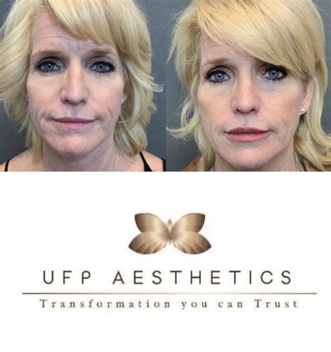 What Is Sculptra And How Does It Work Utah Facial Plastics