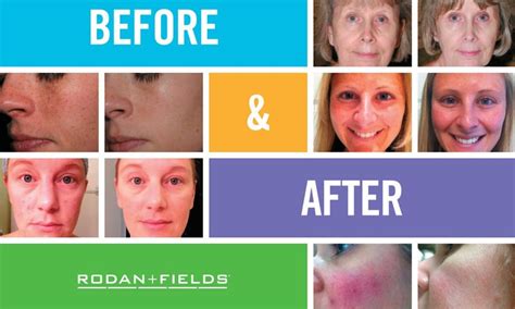 Rodan And Fields Randf The Story Sollay Cosmetic Medical And Laser