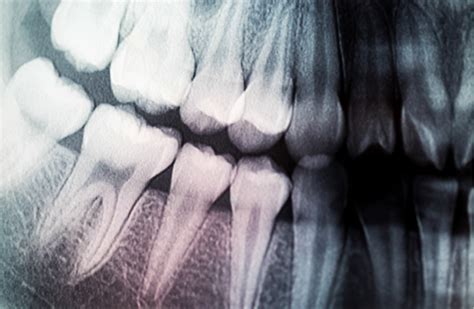 Dental X Rays • Brad Schoonover Dds
