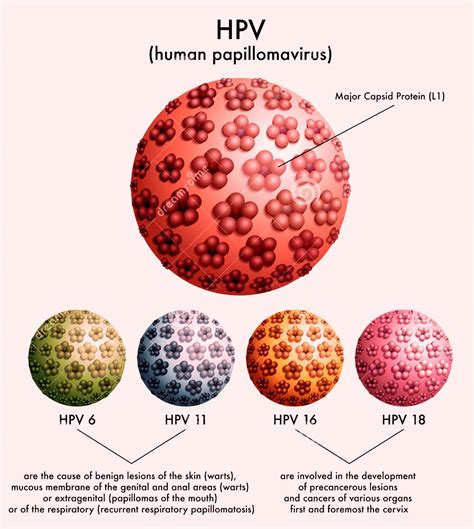 They can cause warts on different parts of your body. Living with HIV and other LGBTQ Issues!!: HPV and HIV ...
