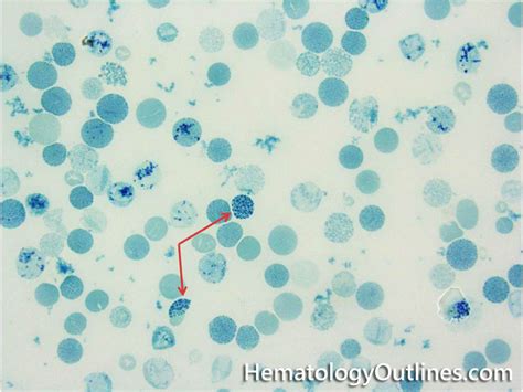 Hemoglobin Inclusion Bodies