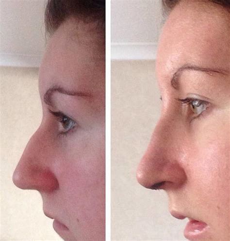 Deviated Septum Before And After 14 Rhinoplasty Cost Pics