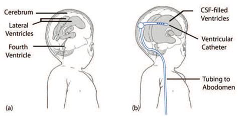 Illustration Of Hydrocephalus A The Ventricular System Of A Normal