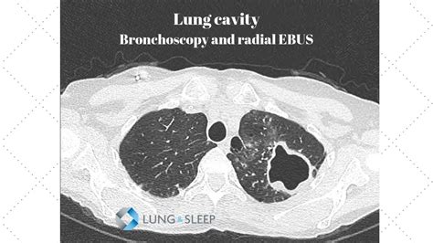 Lung Cavity Bronchoscopy With Radial Endobronchial Ultrasound Ebus