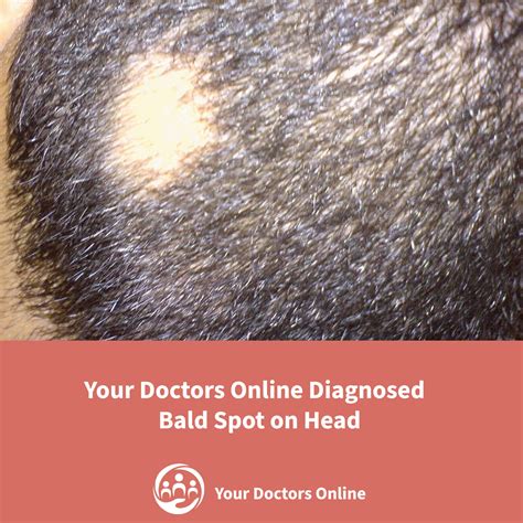 How Your Doctors Online Helped Diagnose The Bald Spot On Head
