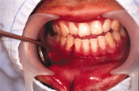 Initial view of the infected tooth #42 in the line of a ...