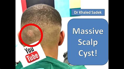 Massive Cyst Eruption Dr Khaled Sadek Youtube