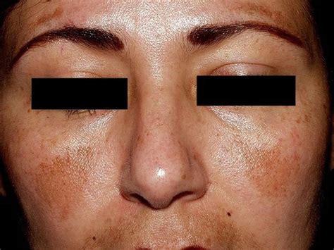 Melasma Causes Symptoms Diagnosis And Best Treatment For Melasma On Face