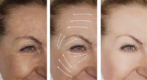 Woman Wrinkles Face Before And After Lifting Contrast Procedures