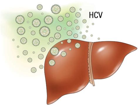 Hepatitis C Hcv Aga Gi Patient Center