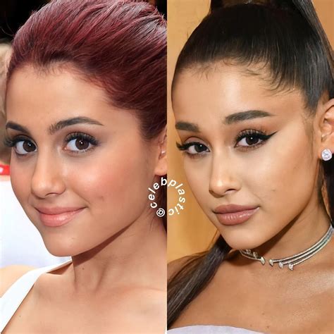Celebrity Plastic On Instagram “ariana Grande Then And Now I Redid This Post With Better Recent