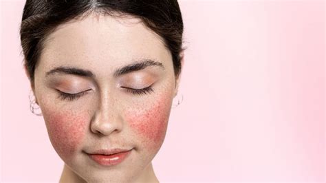 Eczema Vs Rosacea How To Tell The Difference Page 3 Entirely Health
