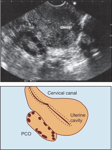 Uterine Cavity Ultrasound
