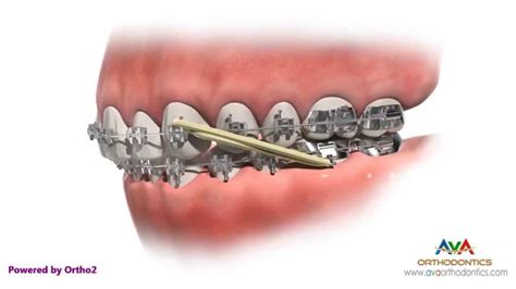 Crossbites can involve a single tooth or multiple teeth, can be bilateral or unilateral, and are often an anterior crossbite with an accompanying deep overbite does not necessarily require a bite plane (a) fixed appliances also can be used to tip teeth out of anterior crossbite. Overjet (AKA Overbite) Treatment by Rubber Bands ...