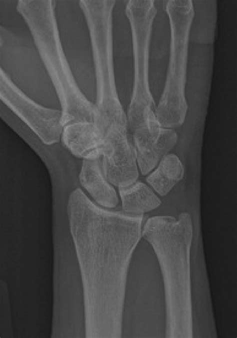 Ulnar Sided Wrist Pain In The Athlete Clinics In Sports Medicine