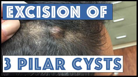 Another Scalp With Three Pilar Cysts Youtube