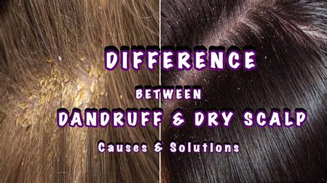 Difference Between Dandruff And Dry Scalpcauses And Solutions Youtube
