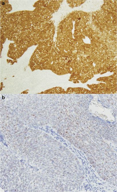 Partial P16 Staining In Oropharyngeal Squamous Cell Carcinoma Extent